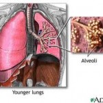 Chronic obstructive pulmonary disease