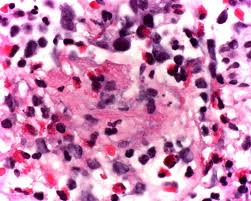 Fatal Pulmonary Aspergillosis Presenting as Acute Eosinophilic Pneumonia in a Previously Healthy Child (3)
