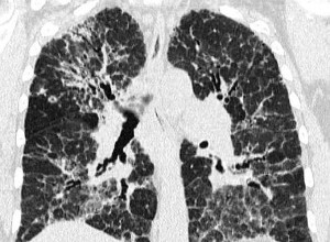 Lung Fibrosis in Hypersensitivity Pneumonitis (3)