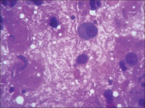 Mycobacterium gordonae: A Treatable Disease in HIV-Positive Patients