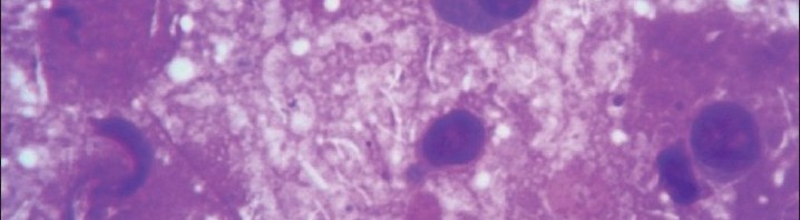 Mycobacterium gordonae: A Treatable Disease in HIV-Positive Patients